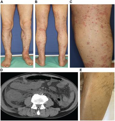 IgA vasculitis induced by carboplatin + nab-paclitaxel + pembrolizumab in a patient with advanced lung squamous cell carcinoma: a case report